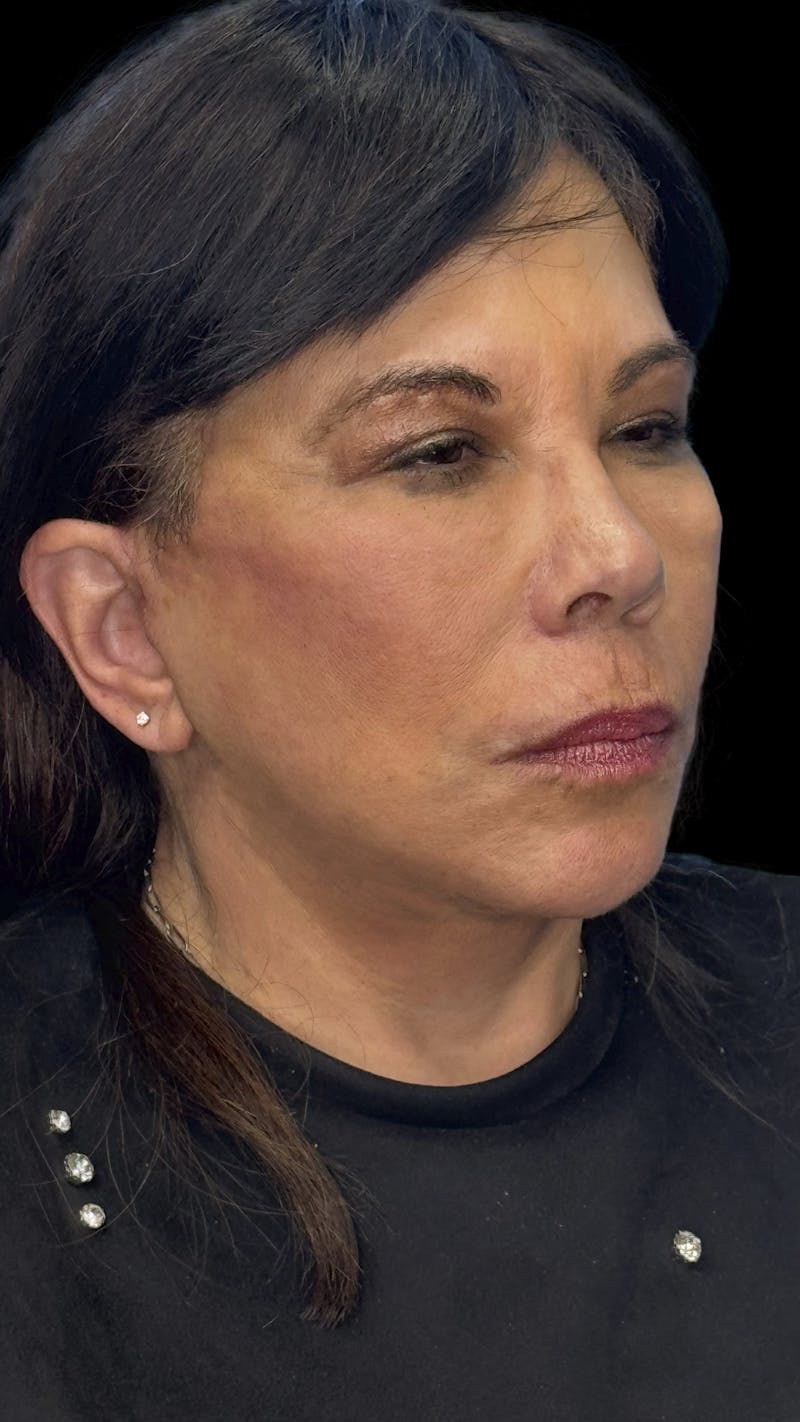 Deep Plane Facelift 70s Before & After Gallery - Patient 363827 - Image 3