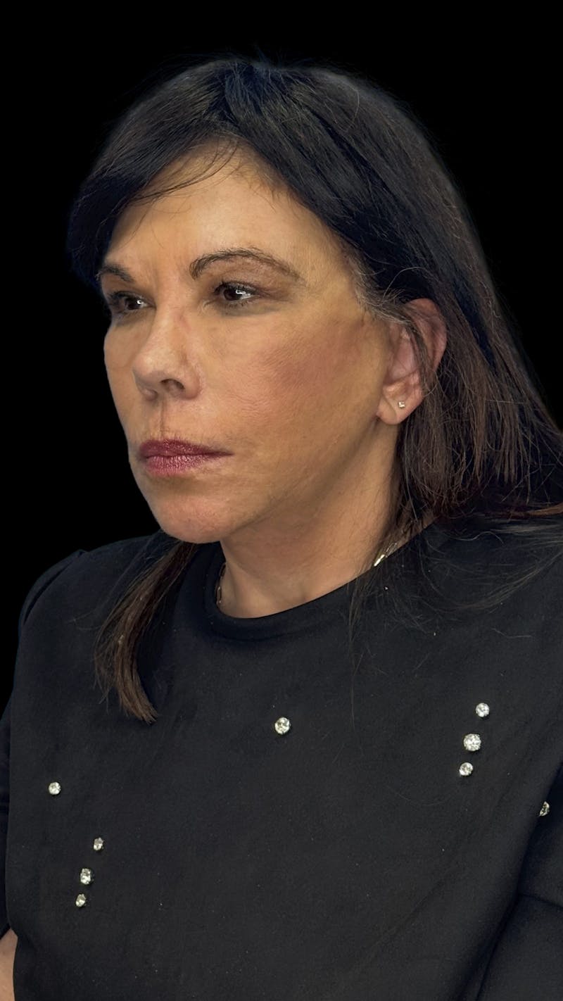 Deep Plane Facelift 70s Before & After Gallery - Patient 363827 - Image 7