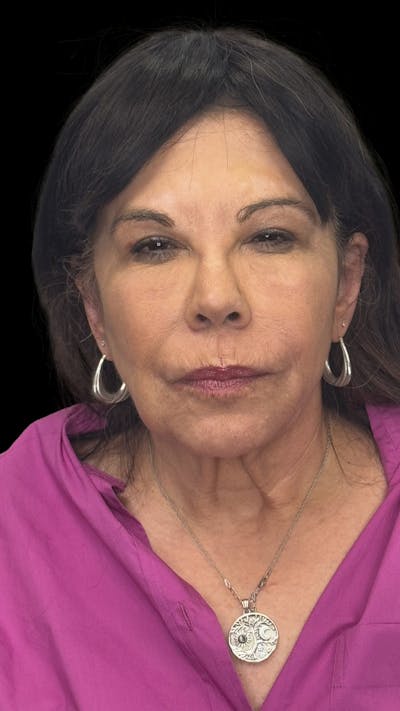 Deep Plane Facelift 70s Before & After Gallery - Patient 363827 - Image 2