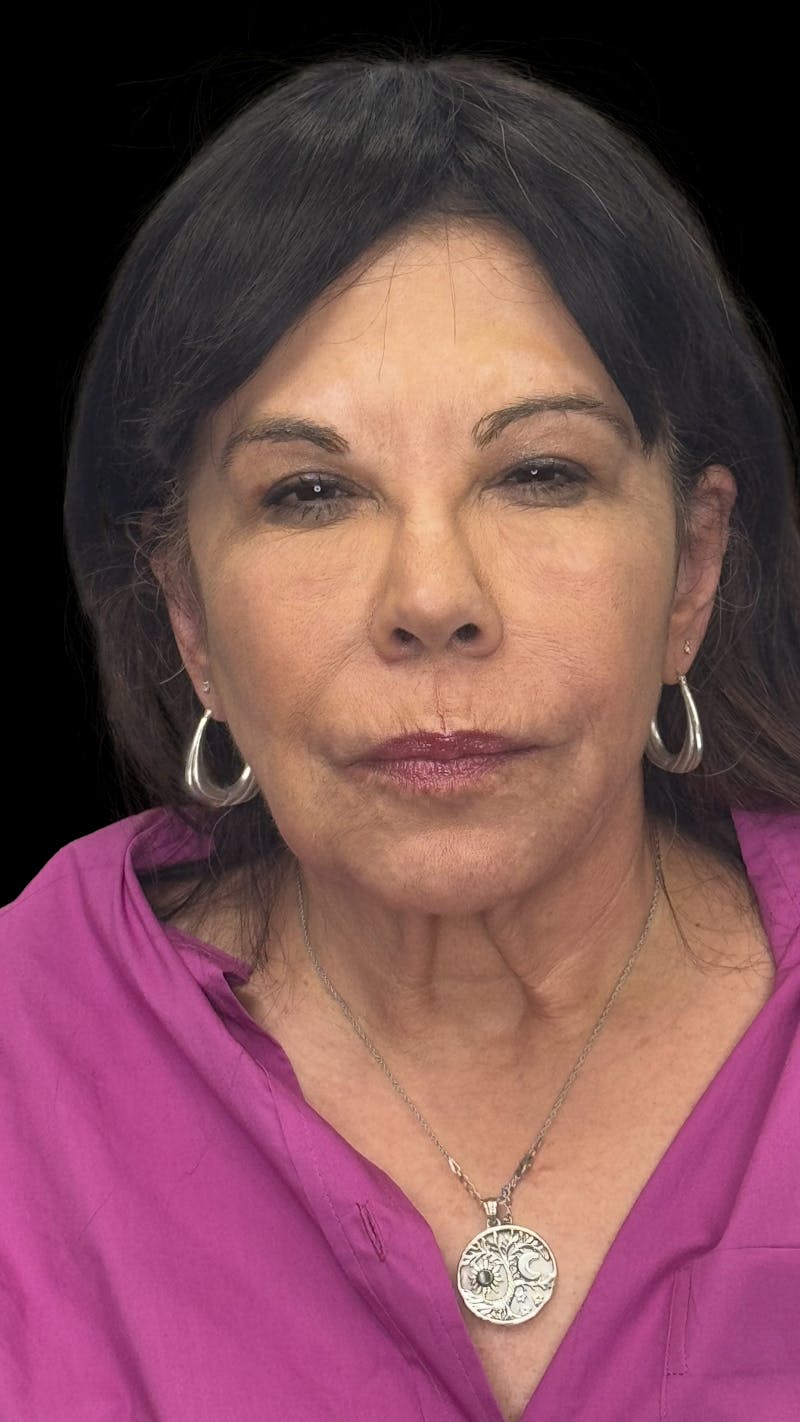 Deep Plane Facelift 70s Before & After Gallery - Patient 363827 - Image 2