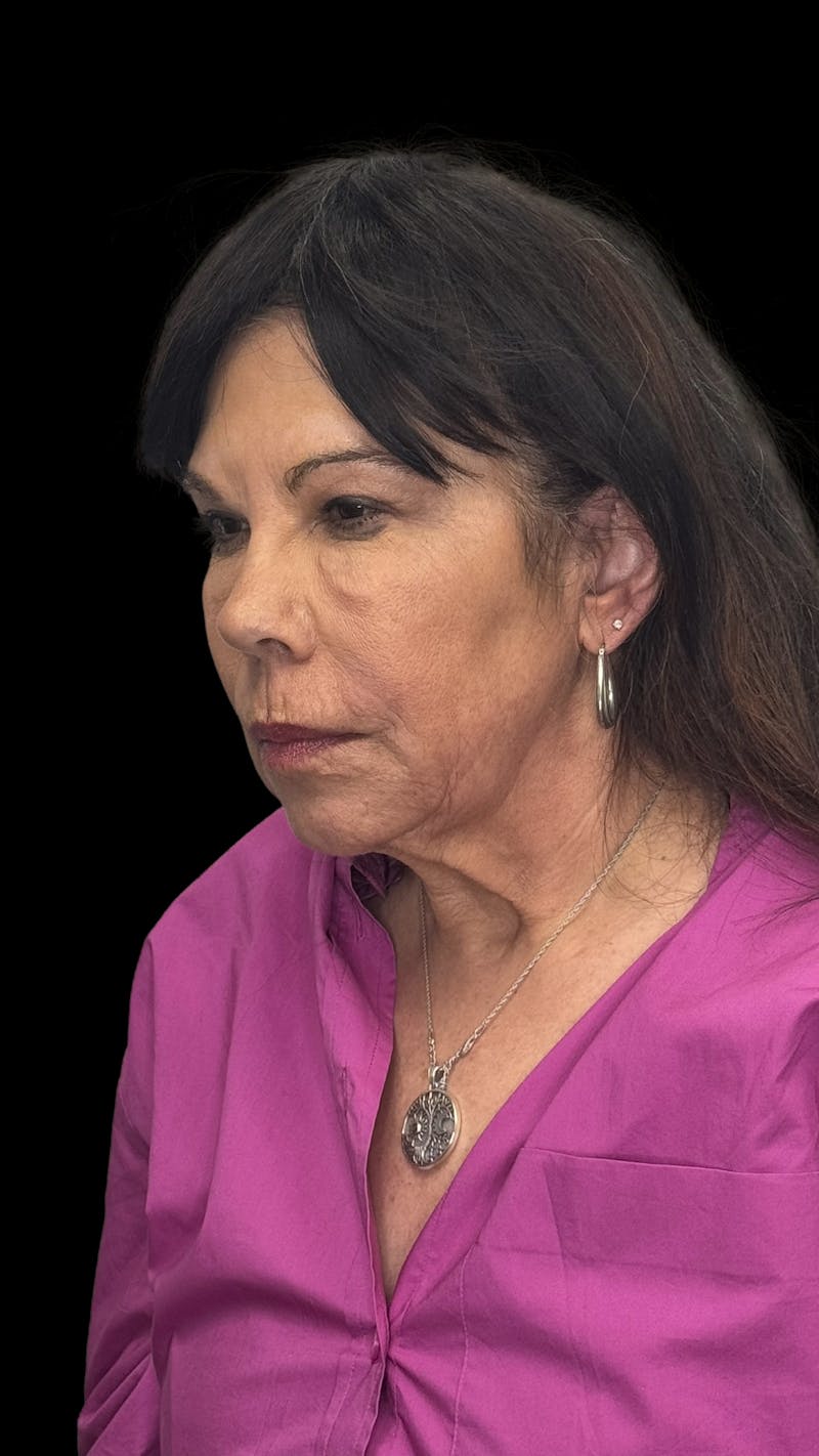 Deep Plane Facelift 70s Before & After Gallery - Patient 363827 - Image 8