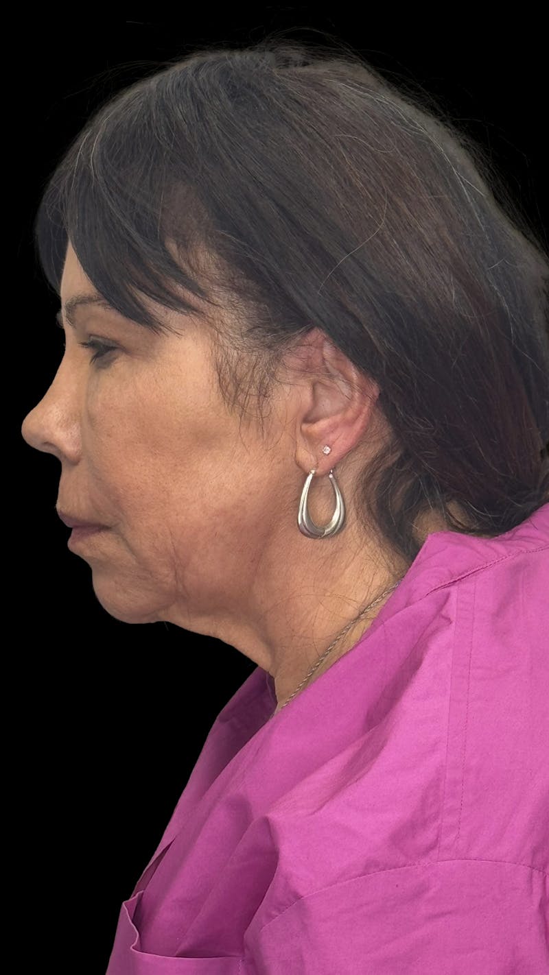 Deep Plane Facelift 70s Before & After Gallery - Patient 363827 - Image 10