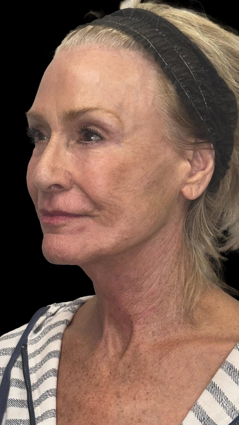 Lip Lift Before & After Gallery - Patient 206754 - Image 4