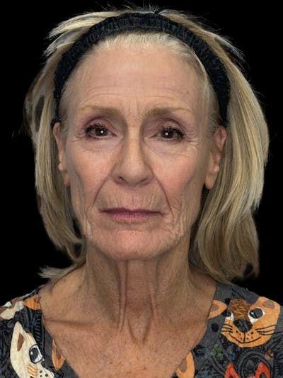 Deep Plane Facelift 70s Before & After Gallery - Patient 127664 - Image 1