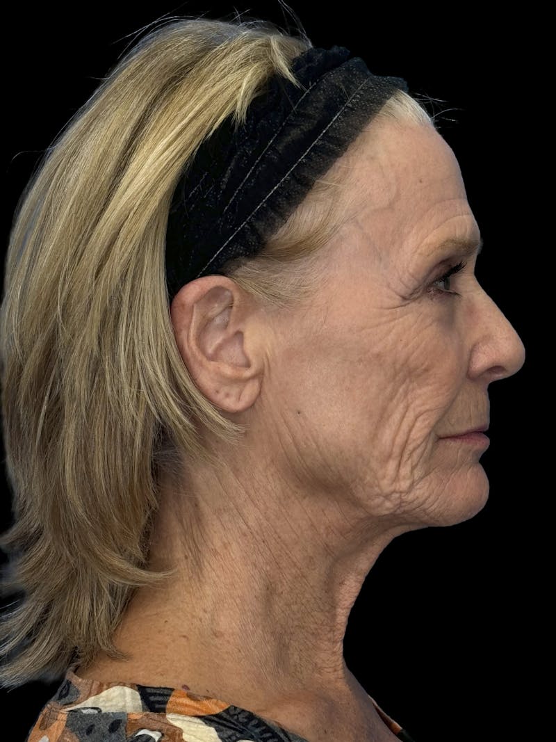 Lip Lift Before & After Gallery - Patient 206754 - Image 9