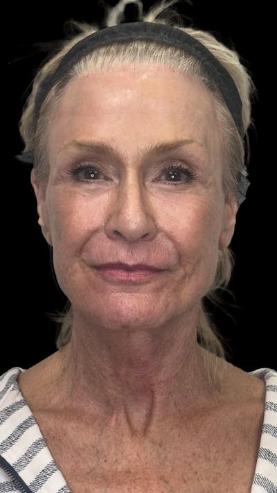 Deep Plane Facelift 70s Before & After Gallery - Patient 127664 - Image 2