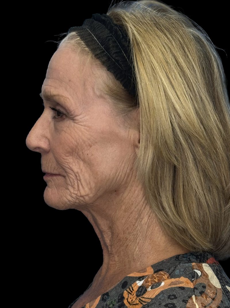 Lip Lift Before & After Gallery - Patient 206754 - Image 5