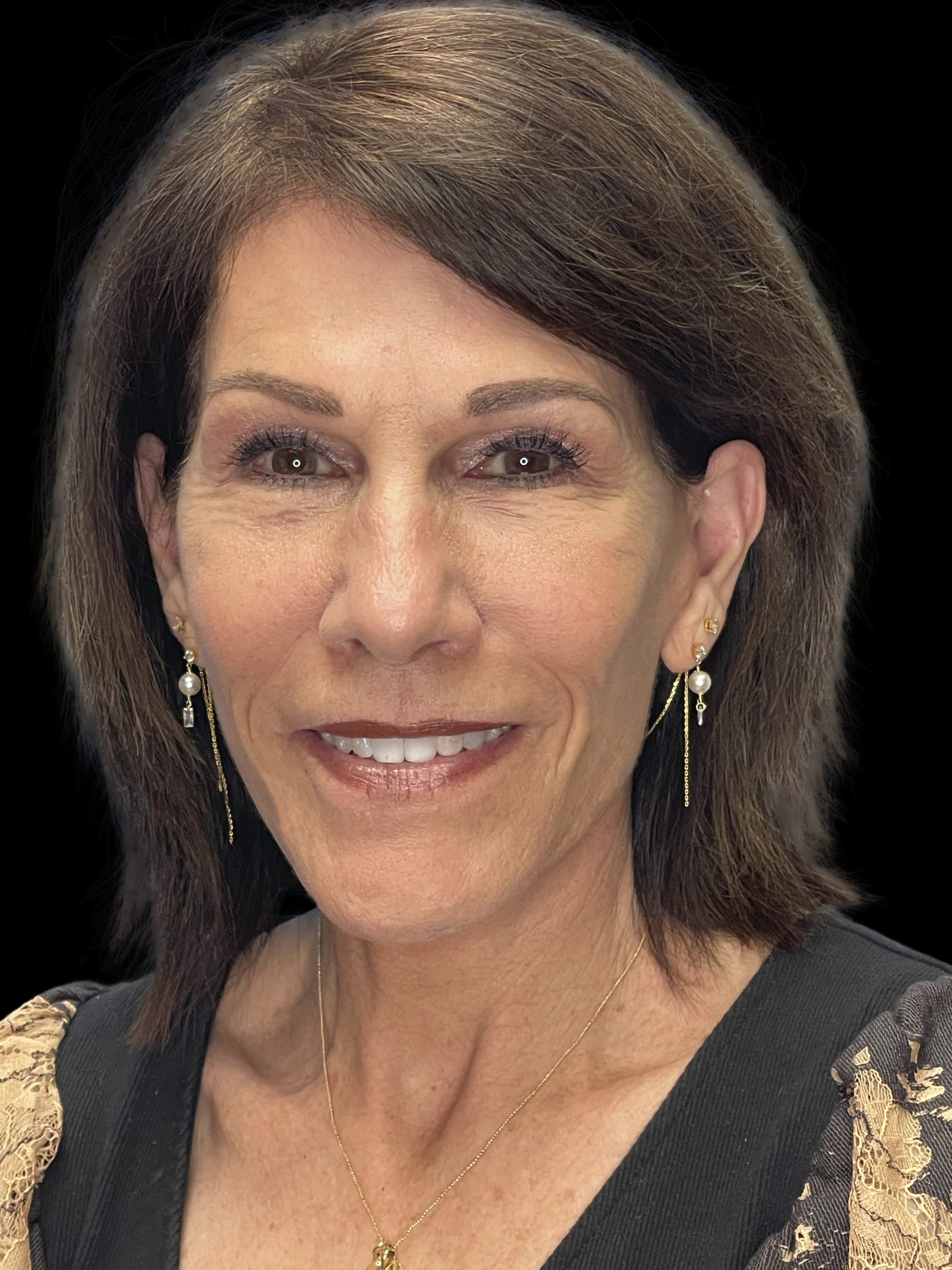 Patient 356352 | Deep Plane Facelift 70s Before & After Photos