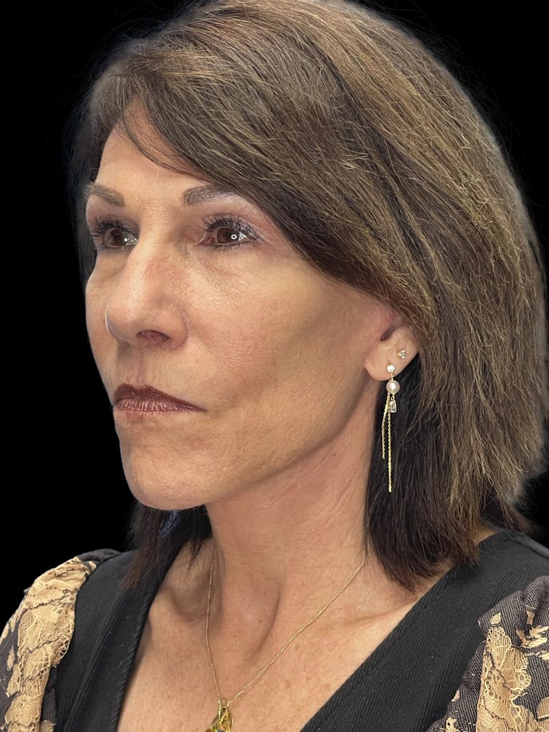 Deep Plane Facelift 70s Before & After Gallery - Patient 356352 - Image 4