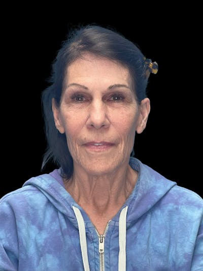 Deep Plane Facelift 70s Before & After Gallery - Patient 356352 - Image 1