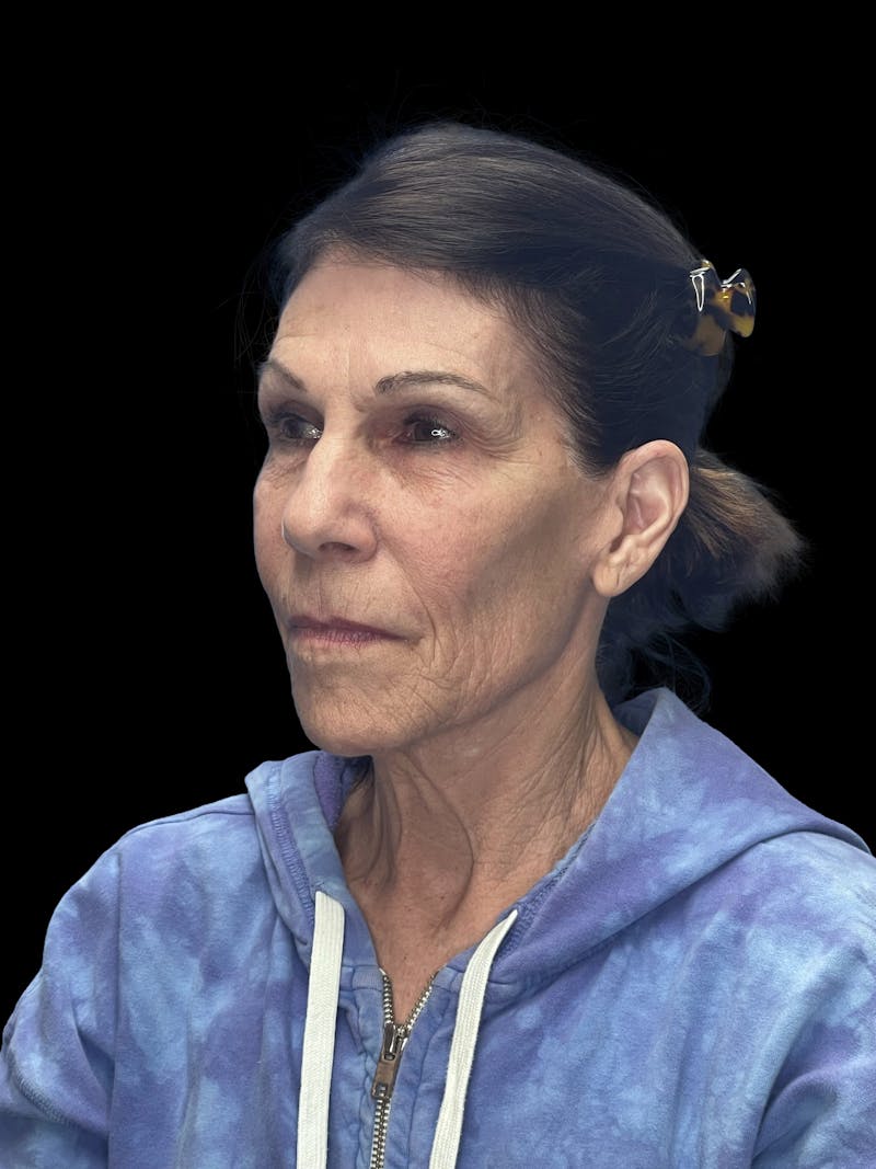 Deep Plane Facelift 70s Before & After Gallery - Patient 356352 - Image 3