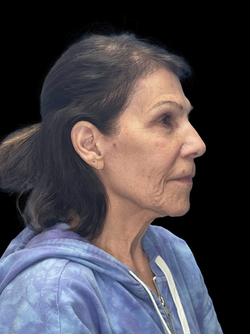 Deep Plane Facelift 70s Before & After Gallery - Patient 356352 - Image 9