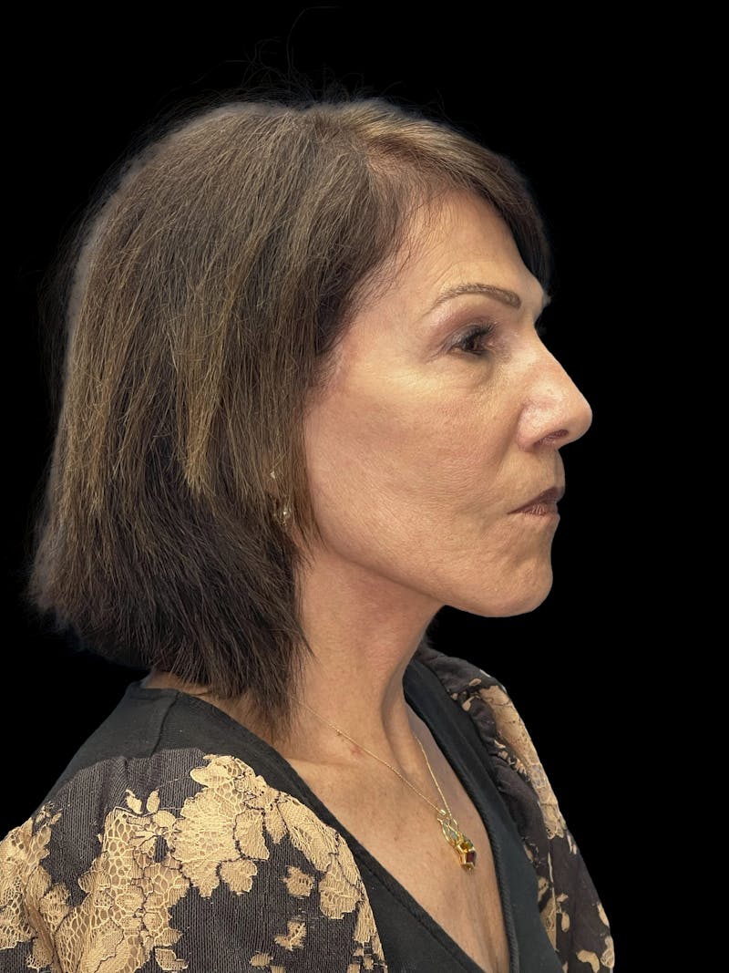 Deep Plane Facelift 70s Before & After Gallery - Patient 356352 - Image 10
