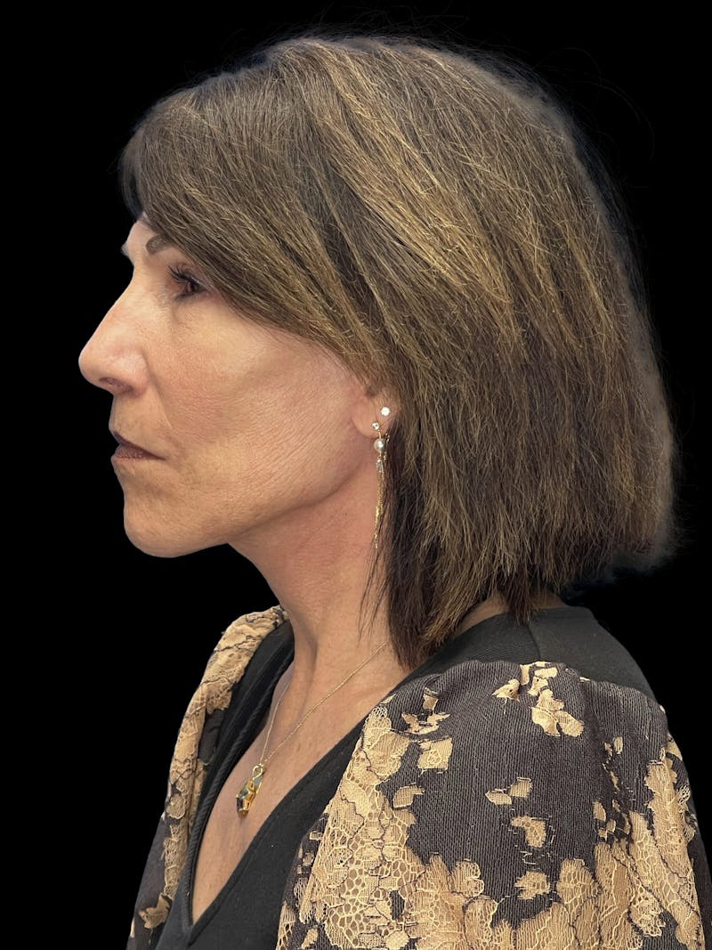 Deep Plane Facelift 70s Before & After Gallery - Patient 356352 - Image 6