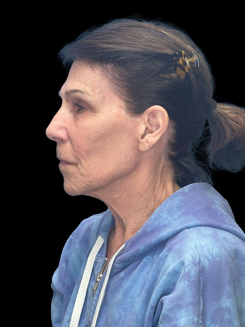 Deep Plane Facelift 70s Before & After Gallery - Patient 356352 - Image 5