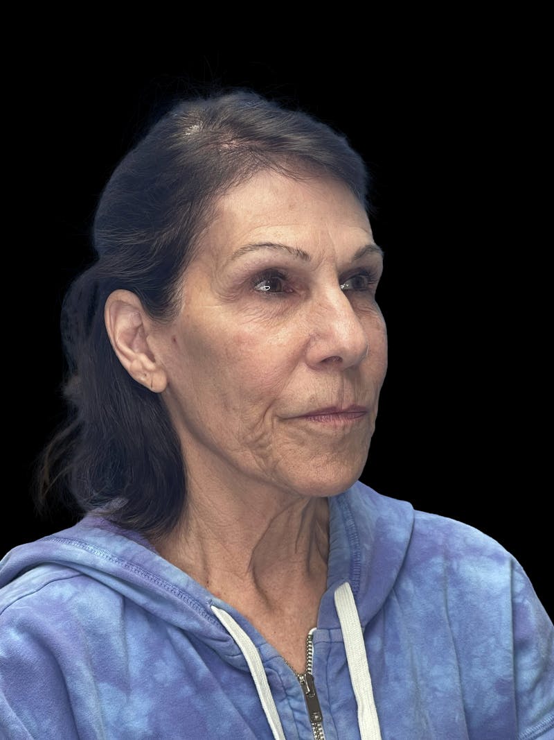 Deep Plane Facelift 70s Before & After Gallery - Patient 356352 - Image 7