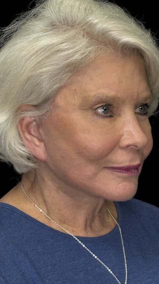 Deep Plane Facelift 70s Before & After Gallery - Patient 166650 - Image 4