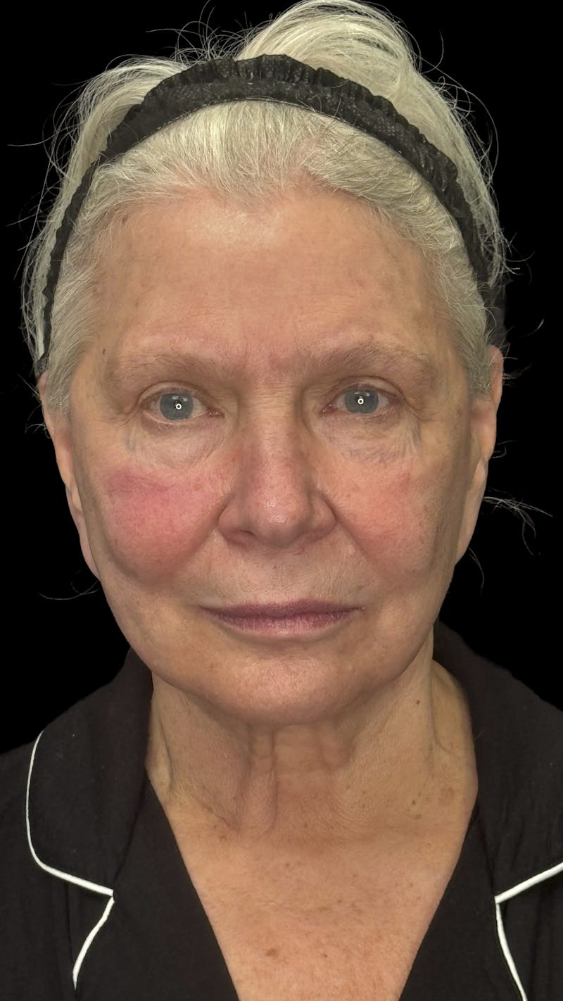 Deep Plane Facelift 70s Before & After Gallery - Patient 166650 - Image 1
