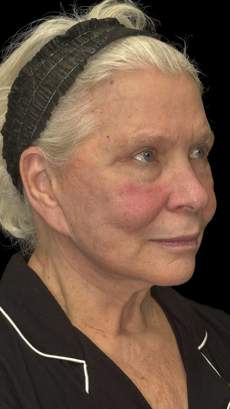 Deep Plane Facelift 70s Before & After Gallery - Patient 166650 - Image 3