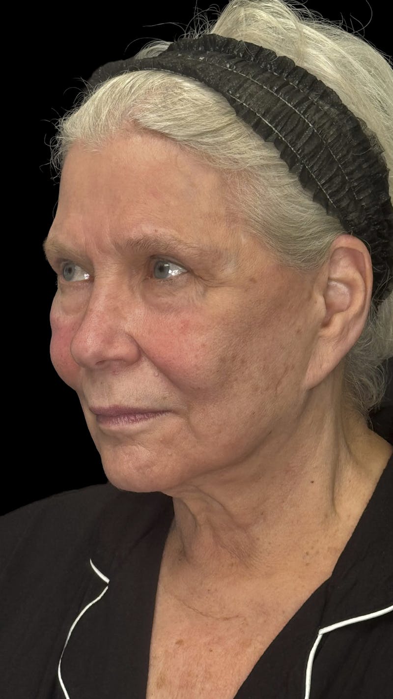 Deep Plane Facelift 70s Before & After Gallery - Patient 166650 - Image 7