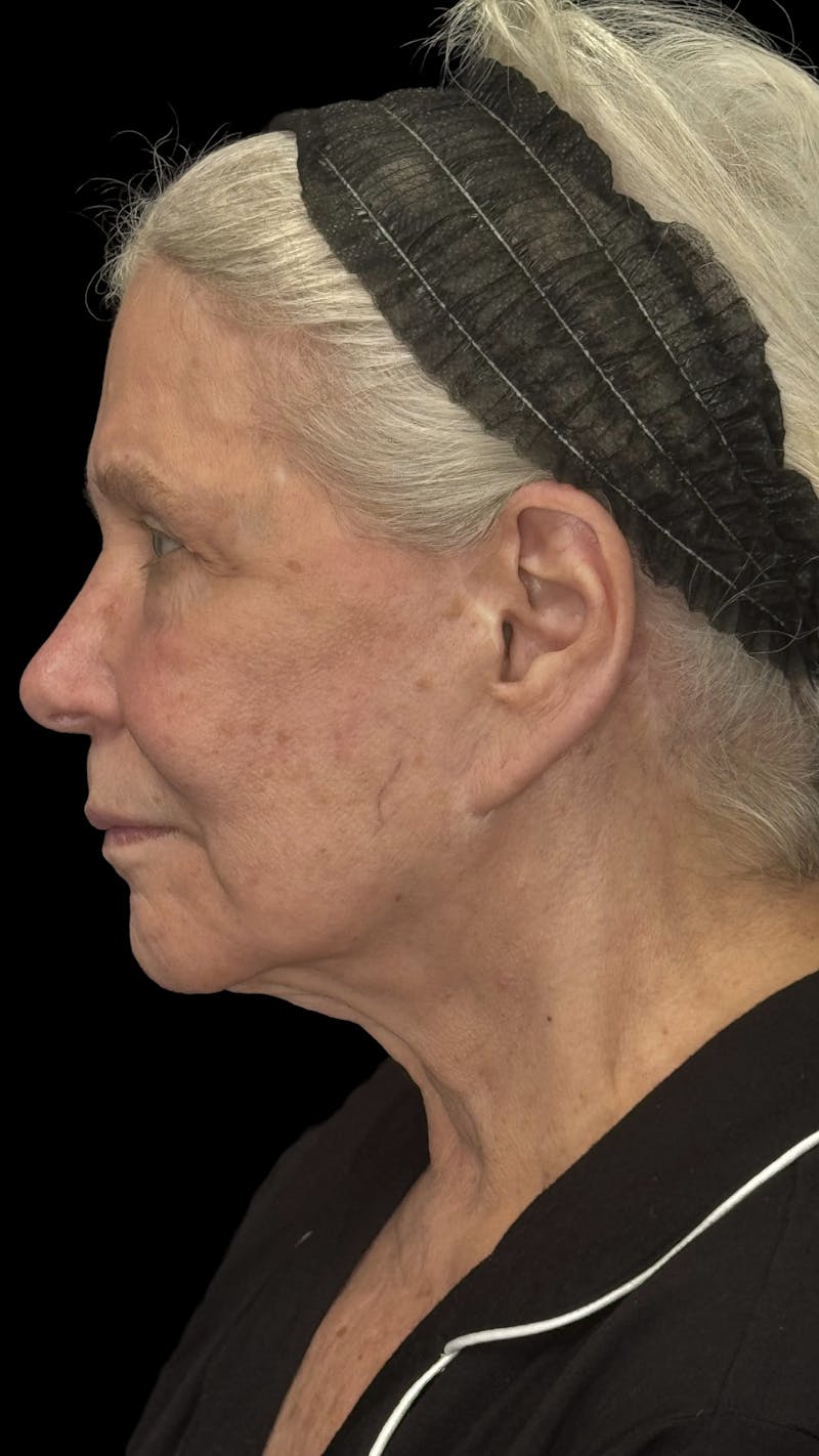Deep Plane Facelift 70s Before & After Gallery - Patient 166650 - Image 9