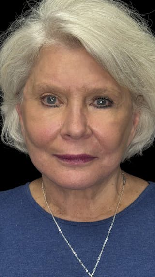 Deep Plane Facelift 70s Before & After Gallery - Patient 166650 - Image 2