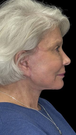 Deep Plane Facelift 70s Before & After Gallery - Patient 166650 - Image 6
