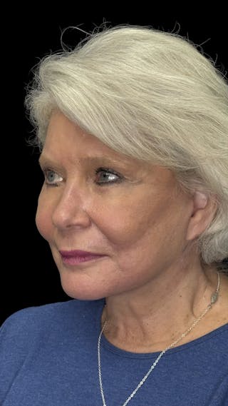 Deep Plane Facelift 70s Before & After Gallery - Patient 166650 - Image 8