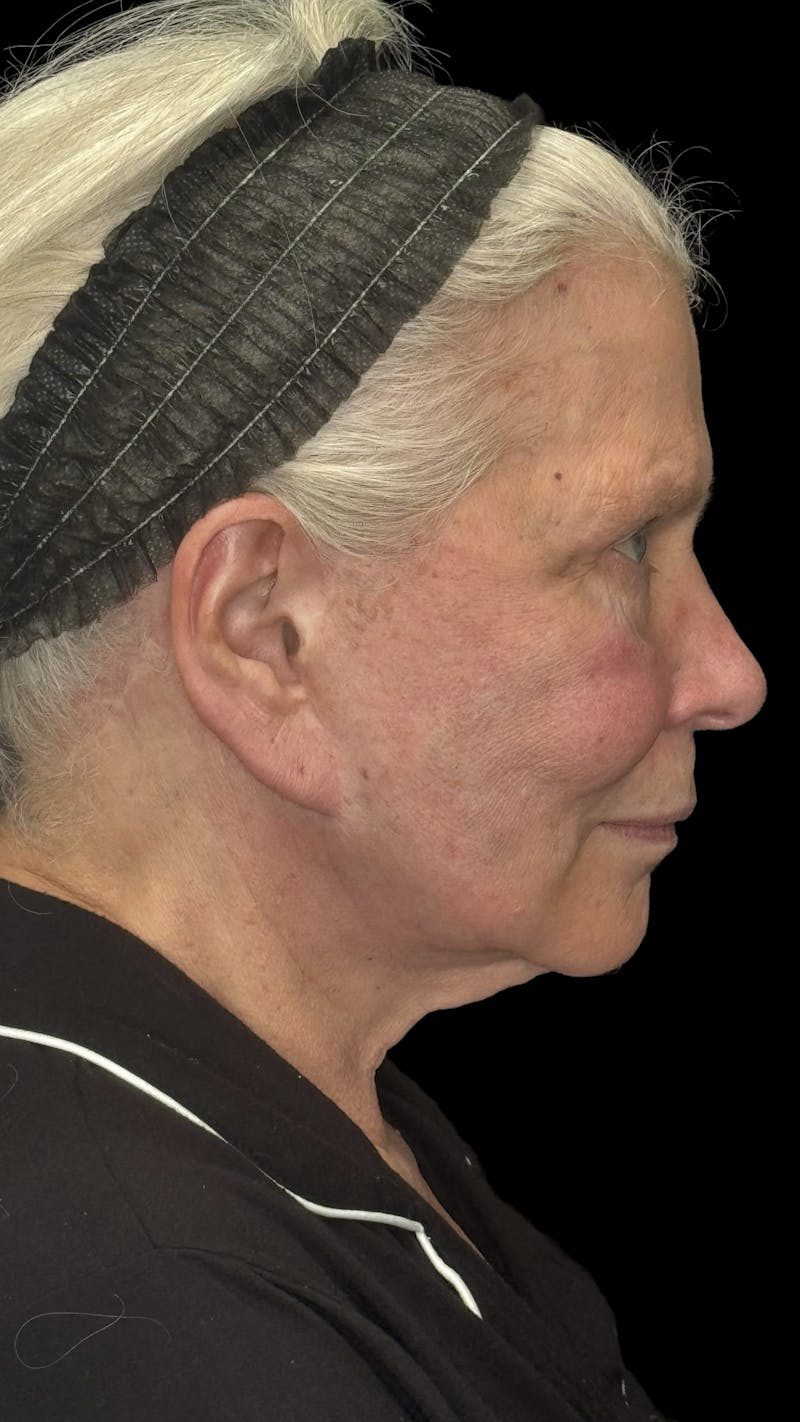 Deep Plane Facelift 70s Before & After Gallery - Patient 166650 - Image 5