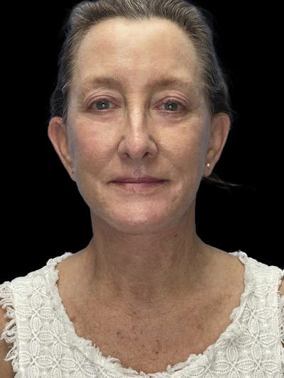 Deep Plane Facelift 60s Before & After Gallery - Patient 209038 - Image 2