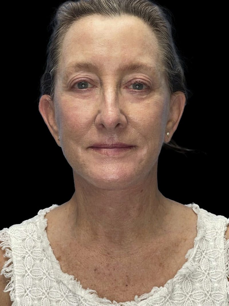 Deep Plane Facelift 60s Before & After Gallery - Patient 209038 - Image 2