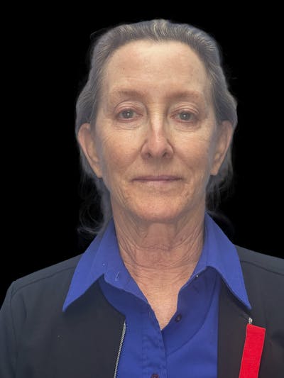 Deep Plane Facelift 60s Before & After Gallery - Patient 209038 - Image 1