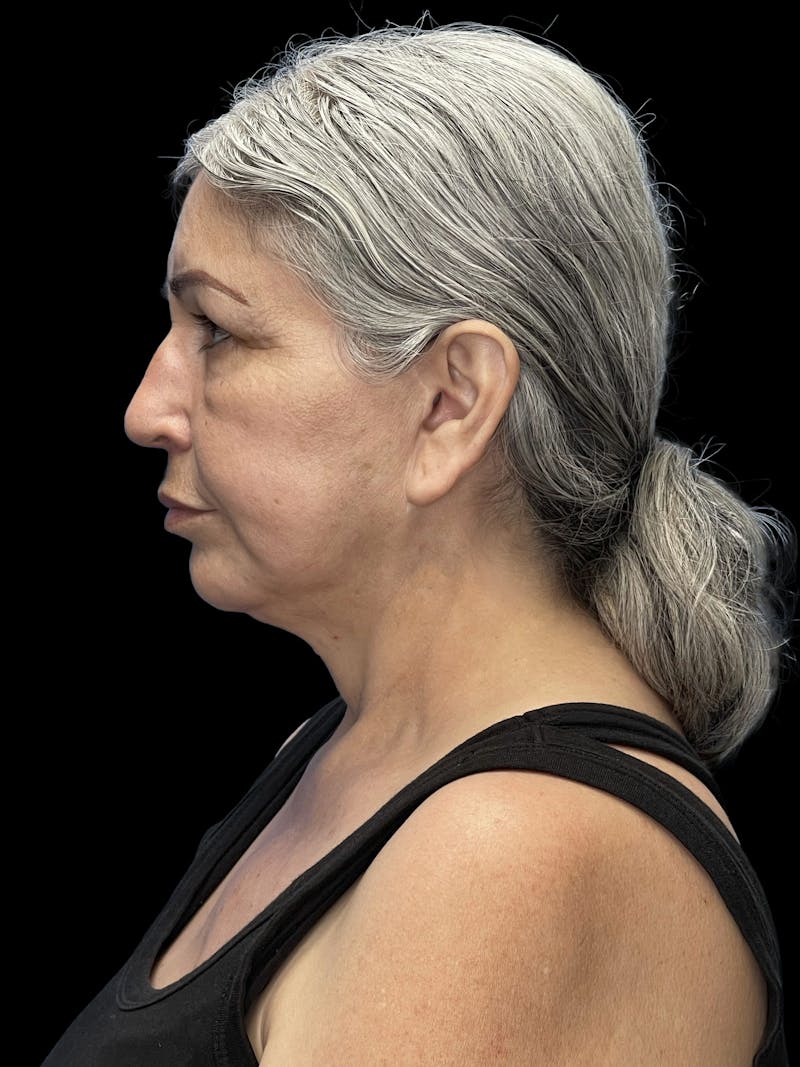 Deep Plane Facelift 60s Before & After Gallery - Patient 238800 - Image 5