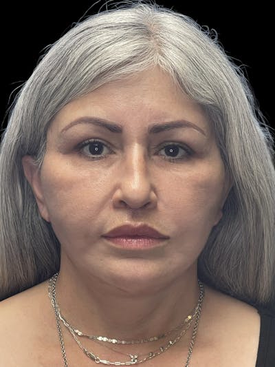 Deep Plane Facelift 60s Before & After Gallery - Patient 238800 - Image 2