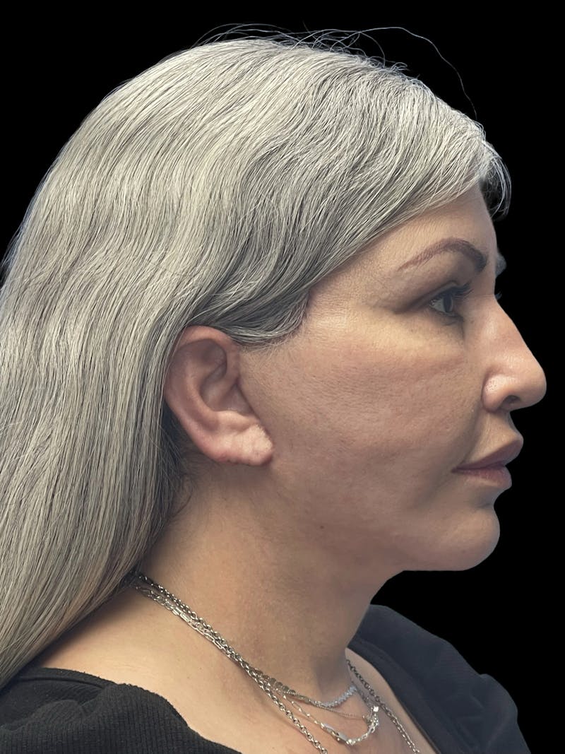 Deep Plane Facelift 60s Before & After Gallery - Patient 238800 - Image 10