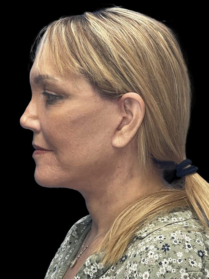Deep Plane Facelift 60s Before & After Gallery - Patient 194146 - Image 6
