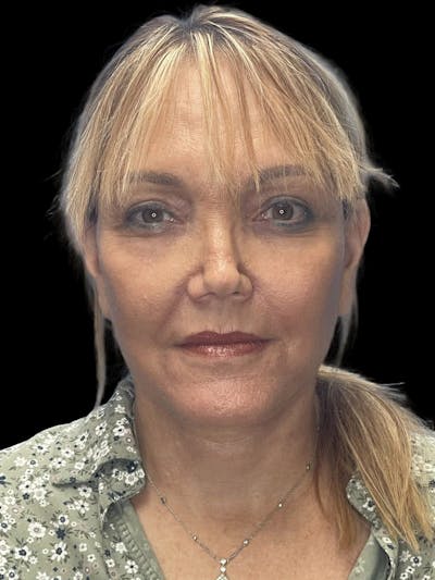 Deep Plane Facelift 60s Before & After Gallery - Patient 194146 - Image 2