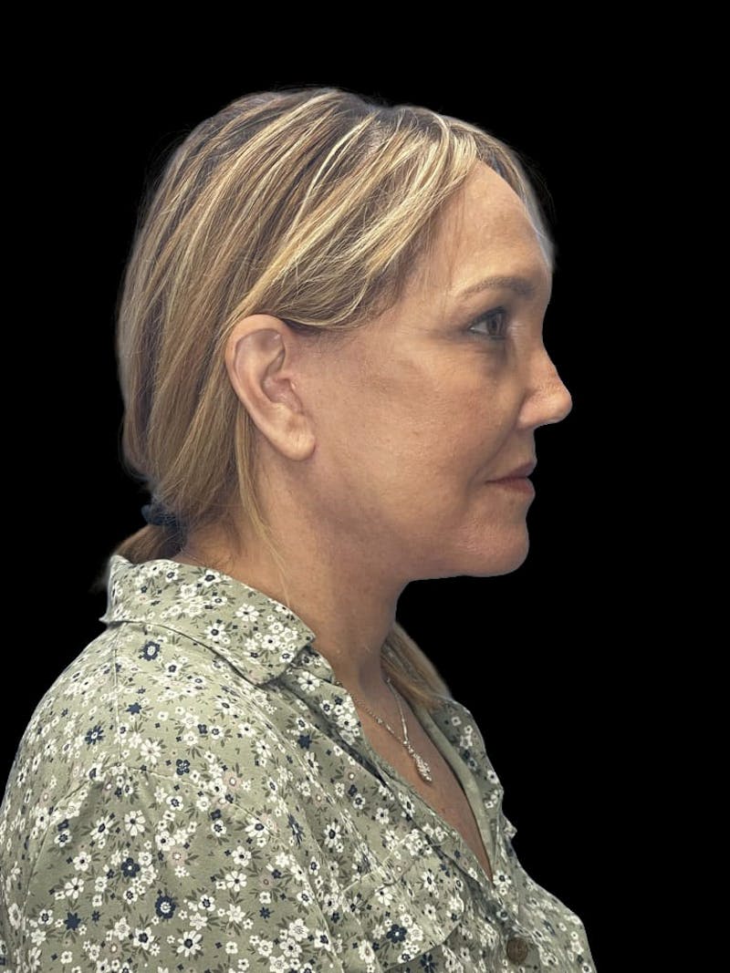 Deep Plane Facelift 60s Before & After Gallery - Patient 194146 - Image 10