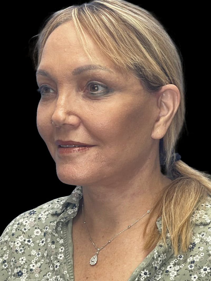 Deep Plane Facelift 60s Before & After Gallery - Patient 194146 - Image 4