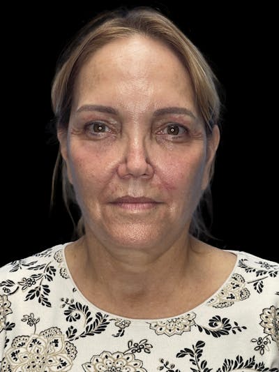 Deep Plane Facelift 60s Before & After Gallery - Patient 194146 - Image 1