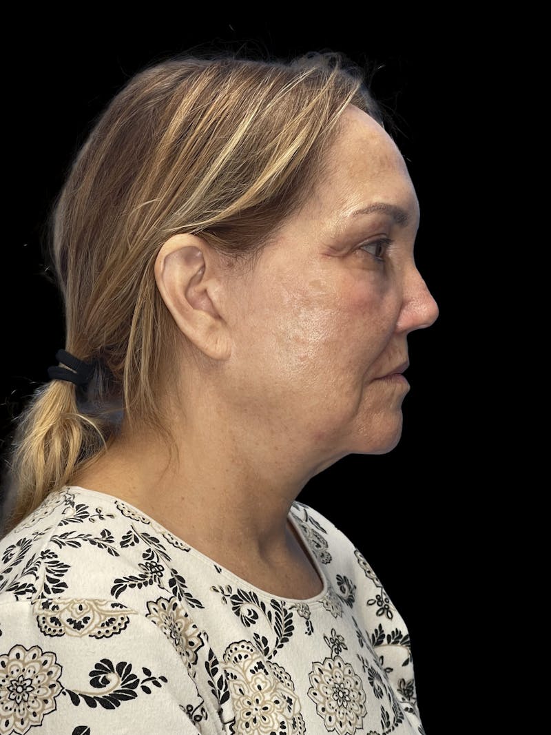 Deep Plane Facelift 60s Before & After Gallery - Patient 194146 - Image 9