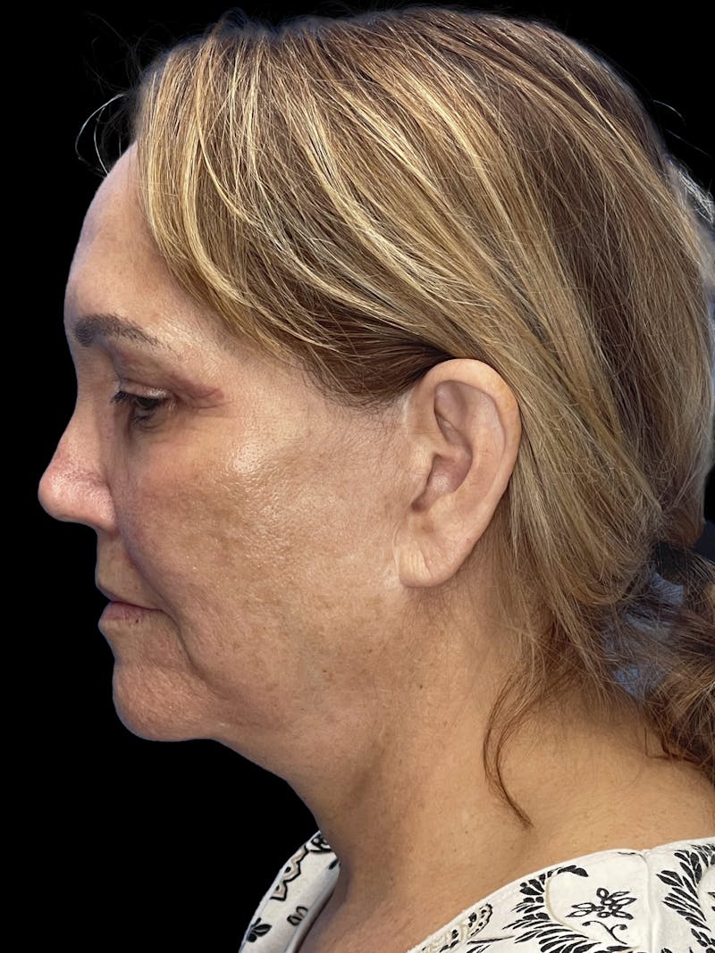Deep Plane Facelift 60s Before & After Gallery - Patient 194146 - Image 5