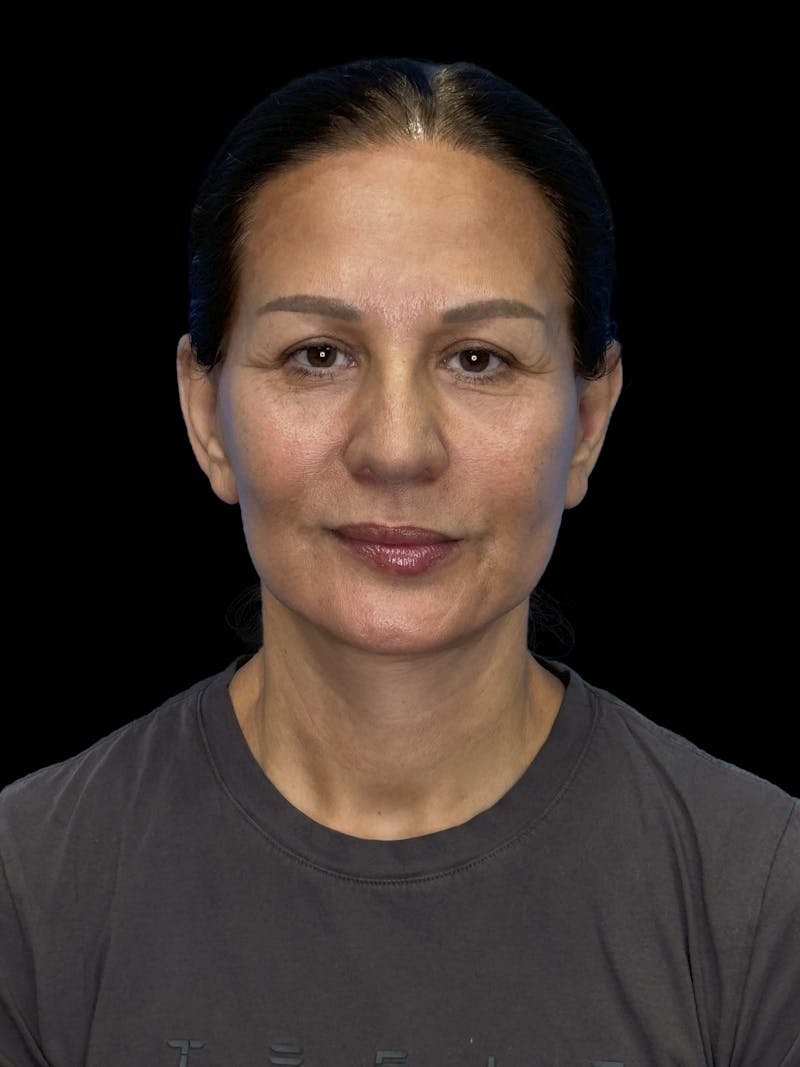 Deep Plane Facelift 60s Before & After Gallery - Patient 279154 - Image 2