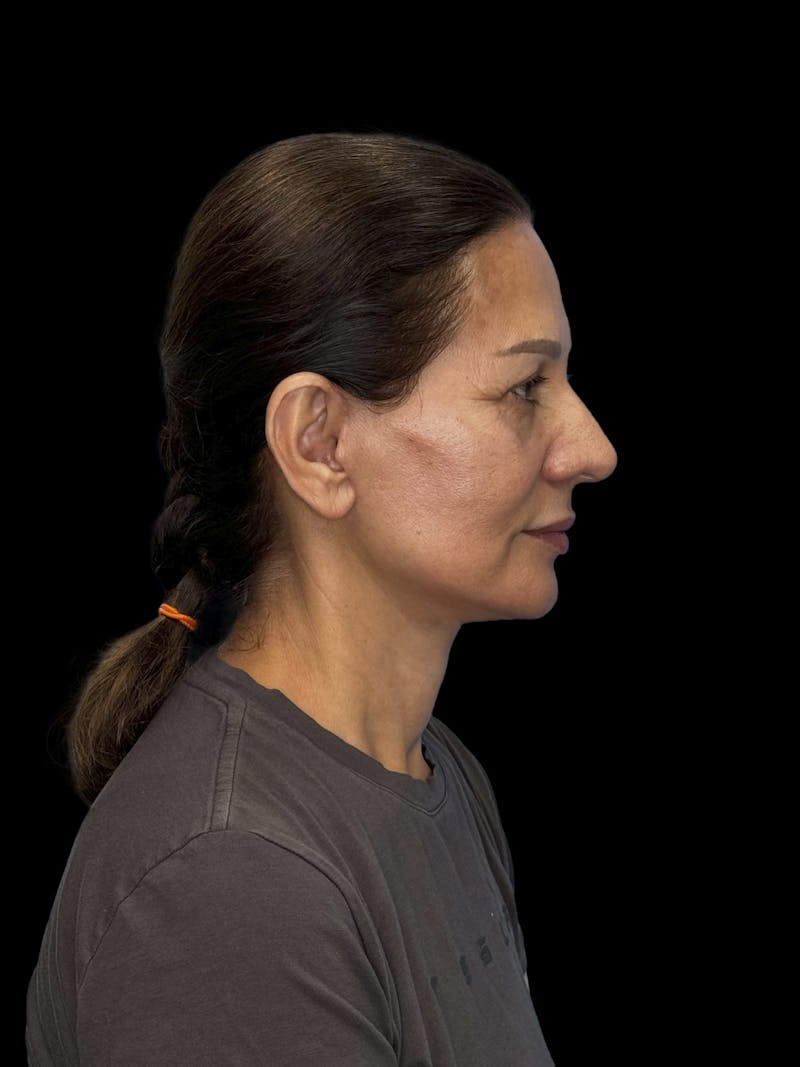 Deep Plane Facelift 60s Before & After Gallery - Patient 279154 - Image 10