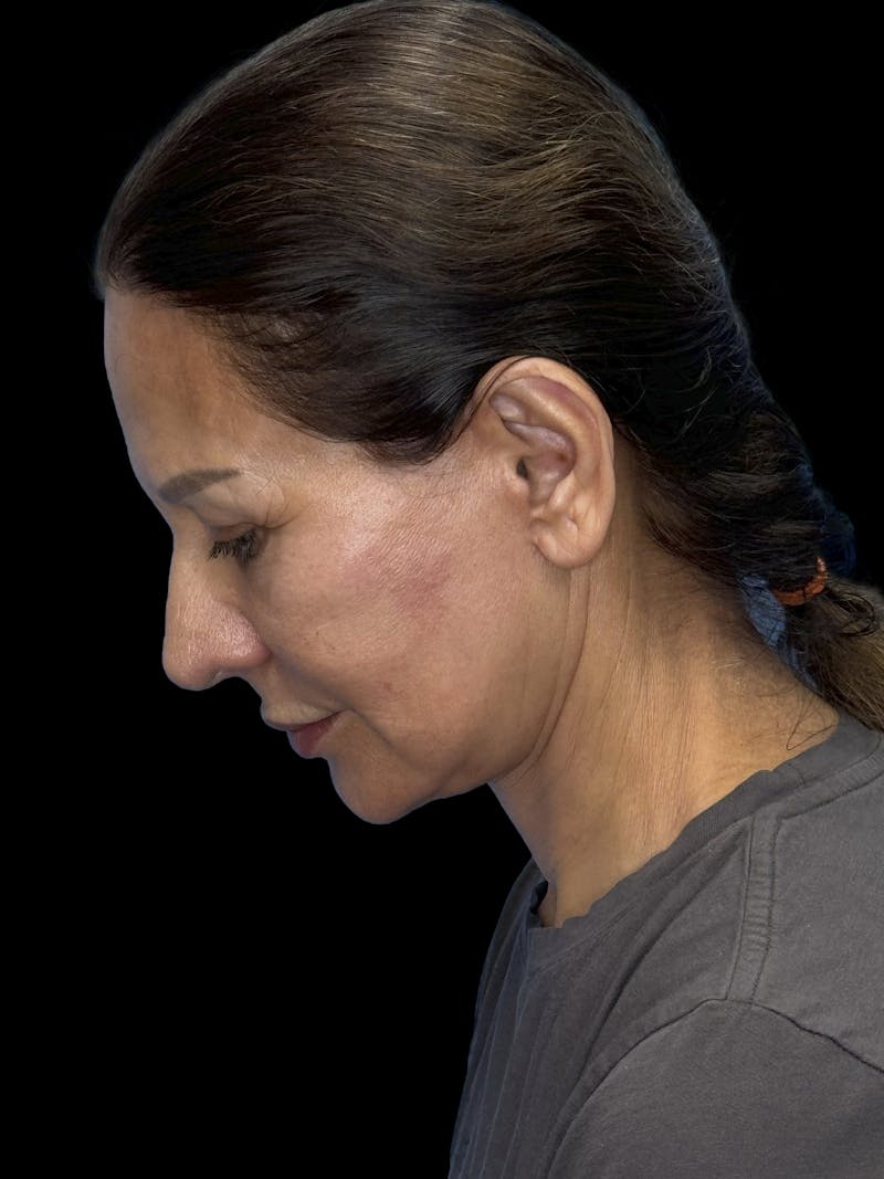 Deep Plane Facelift 60s Before & After Gallery - Patient 279154 - Image 6