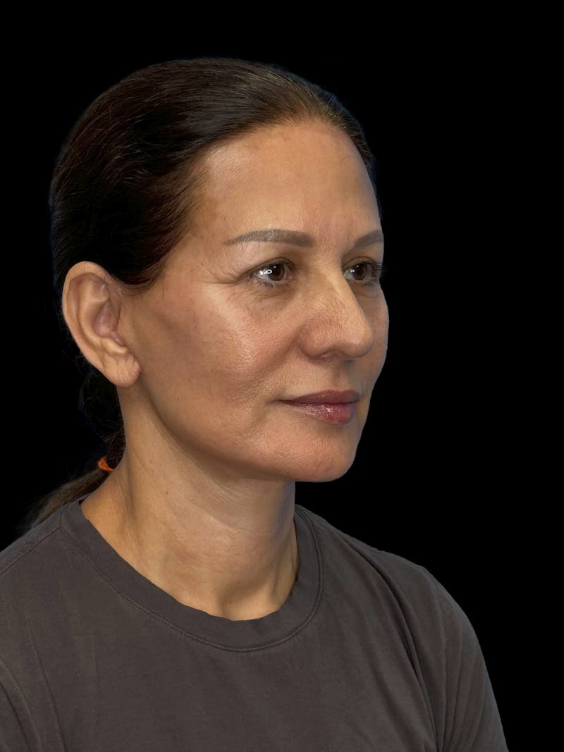 Deep Plane Facelift 60s Before & After Gallery - Patient 279154 - Image 8