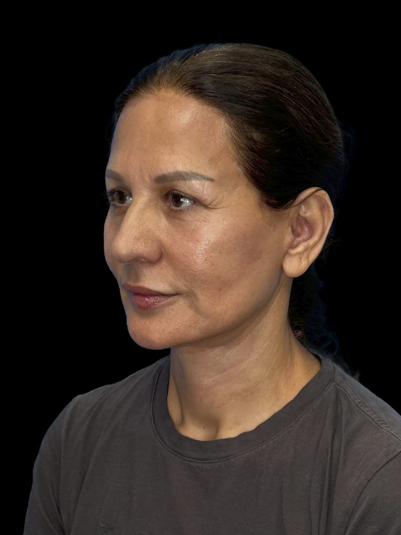 Deep Plane Facelift 60s Before & After Gallery - Patient 279154 - Image 4