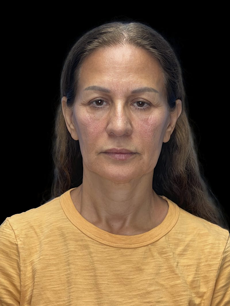 Deep Plane Facelift 60s Before & After Gallery - Patient 279154 - Image 1