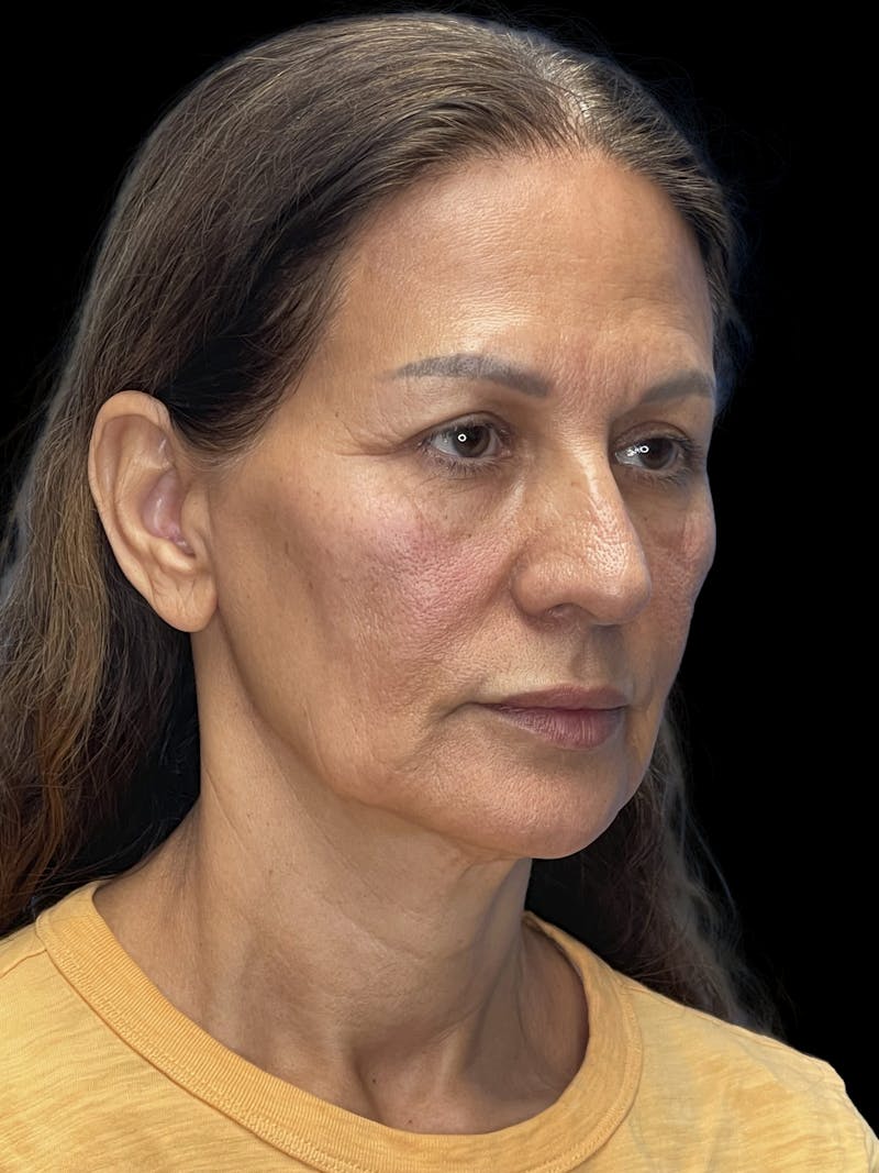 Deep Plane Facelift 60s Before & After Gallery - Patient 279154 - Image 7