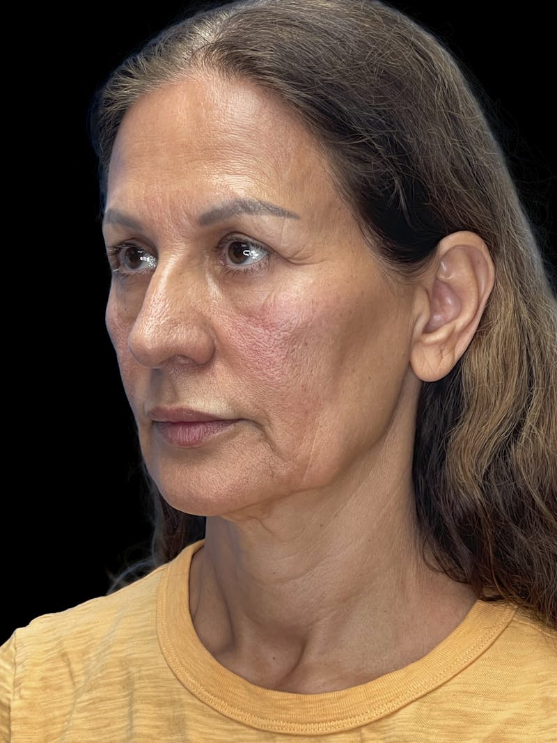 Deep Plane Facelift 60s Before & After Gallery - Patient 279154 - Image 3